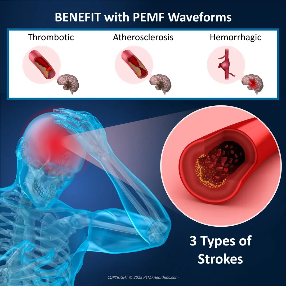 Benefit stroke 2025 1080x1080 Benefit stroke 2025 1080x1080