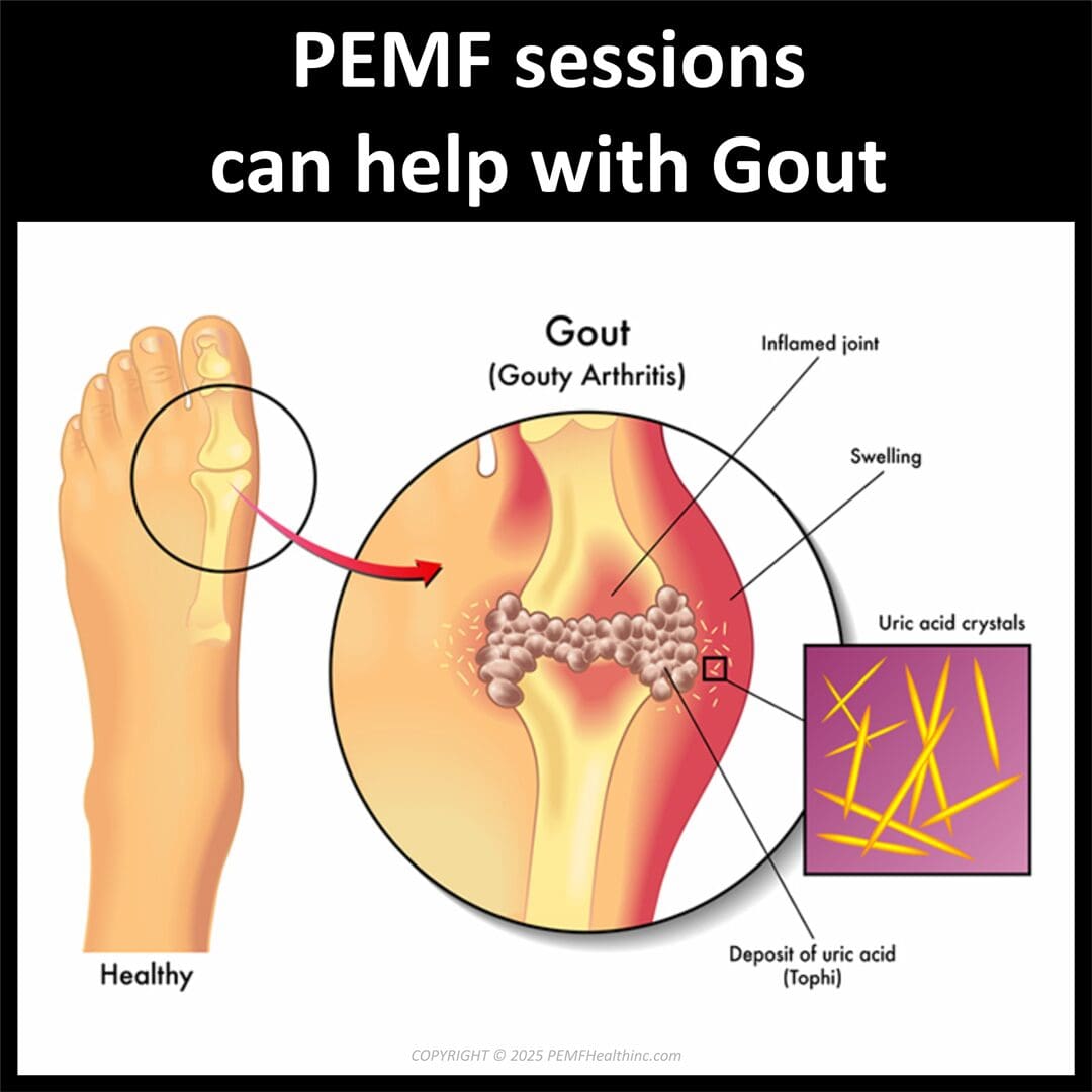 Gout 2025 1080x1080 Gout 2025 1080x1080